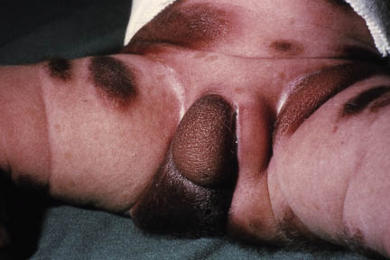 Figura 24. Nevus melanocítico congénito.