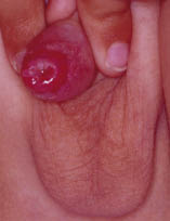 1.Vitoria Fig.33_opt Figura 33. Región bálano-prepucial eritematosa, con secreción purulenta