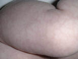 1.Vitoria Fig.5_opt Figura 5. Cutis marmorata.
