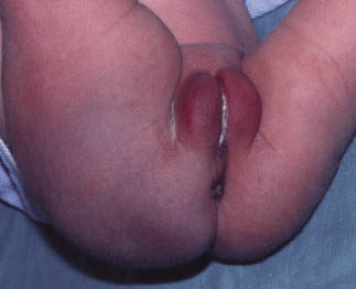 Figura 7. Equimosis en las nalgas tras presentación podálica.