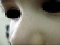 Figura 5. Verrugas planas en el dorso de la nariz.