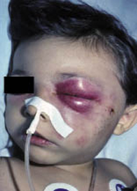 Figura 8. Celulitis orbitaria preseptal estafilocócica secundaria a una herida en la mejilla.