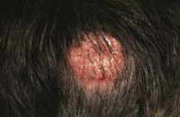 Figura 1. Tinea capitis, forma inflamatoria.