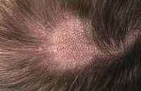 Figura 2. Tinea capitis, forma tonsurante. Figura 2. Tinea capitis, forma tonsurante.