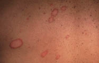 Figura 4. Herpes circinado.Crecimiento radial alrededor del punto de inoculación, zonas hirsutas de cara y cuello.