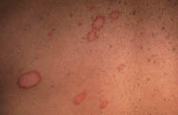 Figura 4. Herpes circinado.Crecimiento radial alrededor del punto de inoculación, zonas hirsutas de cara y cuello. Figura 4. Herpes circinado.Crecimiento radial alrededor del punto de inoculación, zonas hirsutas de cara y cuello.