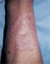 Figura 5. Granuloma de Majochi. Forma profunda con pústulas foliculares y nodulares.