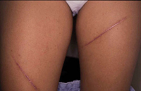 Figura 101. Cicatrices hipertróficas en heridas por roce. Figura 101. Cicatrices hipertróficas en heridas por roce.