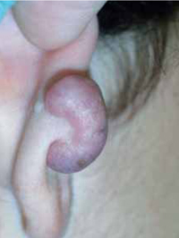Figura 102. Queloide secundario a pendiente. Figura 102. Queloide secundario a pendiente.