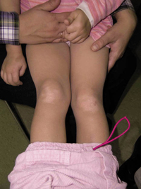 Figura 105. Dermatitis por fricción. Figura 105. Dermatitis por fricción.