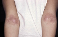 Figura 106. Dermatitis atópica. Figura 106. Dermatitis atópica.