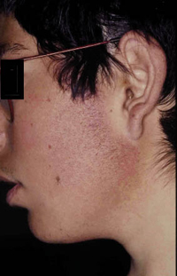 Figura 108. Queratosis pilar. Figura 108. Queratosis pilar.
