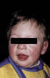 Figura 109. Dermatitis atópica. Figura 109. Dermatitis atópica.