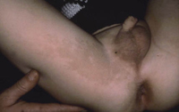 Figura 10. Manchas café con leche (neurofibromatosis). Figura 10. Manchas café con leche (neurofibromatosis).