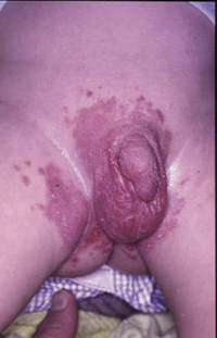 Figura 110. Acrodermatitis enteropática. Figura 110. Acrodermatitis enteropática.