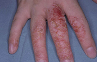Figura 117. Dishidrosis. Figura 117. Dishidrosis.