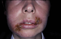Figura 120. Impetiginización en el herpes simple. Figura 120. Impetiginización en el herpes simple.