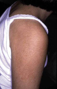 Figura 13. Nevus de Becker. Figura 13. Nevus de Becker.