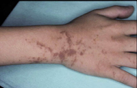 Figura 15. Pigmentación postinflamatoria (dermatitis ampollosa de los prados). Figura 15. Pigmentación postinflamatoria (dermatitis ampollosa de los prados).