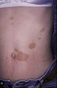 Figura 16. Pitiriasis versicolor (variedad café con leche). Figura 16. Pitiriasis versicolor (variedad café con leche).
