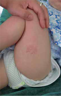 Figura 17. Hemangioma capilar infantil. Figura 17. Hemangioma capilar infantil.