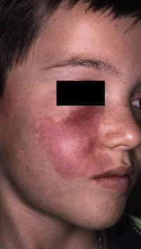 Figura 18. Nevus telangiectásico o flammeus. Figura 18. Nevus telangiectásico o flammeus.