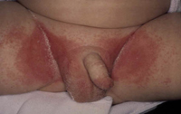 Figura 20. Candidiasis.