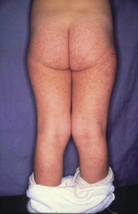 Figura 23. Exantema viral (enf. de Gianotti). Figura 23. Exantema viral (enf. de Gianotti).