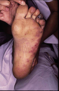 Figura 26. Sepsis. Figura 26. Sepsis.