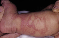 Figura 31. Urticaria. Figura 31. Urticaria.