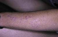 Figura 36. Poroqueratosis de Mibelli. Figura 36. Poroqueratosis de Mibelli.