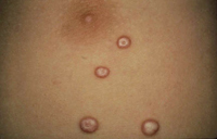 Figura 39. Molusco contagioso. Figura 39. Molusco contagioso.