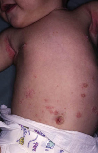 Figura 41. Psoriasis en placas. Figura 41. Psoriasis en placas.