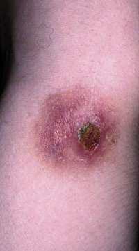 Figura 45. Granuloma por mycobacterias. Figura 45. Granuloma por mycobacterias.