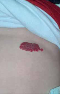 Figura 46. Hemangioma. Figura 46. Hemangioma.