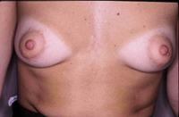Figura 51. Esteatocistoma múltiple. Figura 51. Esteatocistoma múltiple.