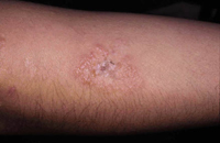 Figura 54. Dermatitis herpetiforme. Figura 54. Dermatitis herpetiforme.