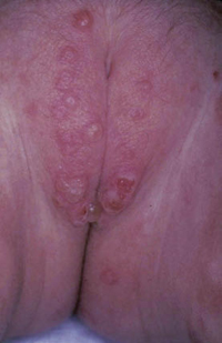 Figura 55. Dermatitis por IgA lineal. Figura 55. Dermatitis por IgA lineal.