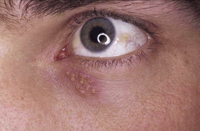 Figura 61. Herpes simple. Figura 61. Herpes simple.