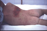 Figura 62. Herpes zoster. Figura 62. Herpes zoster.