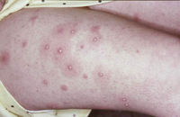 Figura 65. Foliculitis. Figura 65. Foliculitis.