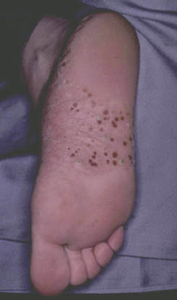 Figura 67. Pustulosis palmoplantar. Figura 67. Pustulosis palmoplantar.