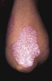 Figura 69. Psoriasis. Figura 69. Psoriasis.