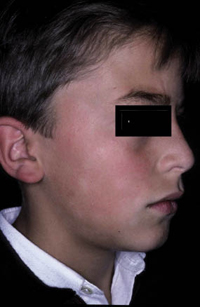 Figura 6. Pitiriasis alba faciei. Figura 6. Pitiriasis alba faciei.