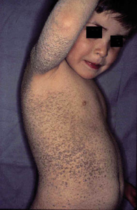 Figura 70. Ictiosis nigricans. Figura 70. Ictiosis nigricans.