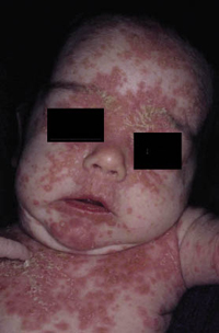 Figura 71. Dermatitis seborreica.