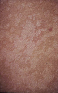 Figura 73. Escamas pequeñas (pitiriasis versicolor). Figura 73. Escamas pequeñas (pitiriasis versicolor).