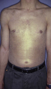 Figura 75. Ictiosis vulgar. Figura 75. Ictiosis vulgar.