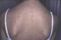 Figura 78. Costras hemorrágicas (dermatitis herpetiforme de During). Figura 78. Costras hemorrágicas (dermatitis herpetiforme de During).