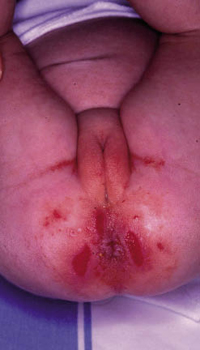 Figura 83. Dermatitis del pañal con erosiones (sifiloide posterosivo). Figura 83. Dermatitis del pañal con erosiones (sifiloide posterosivo).